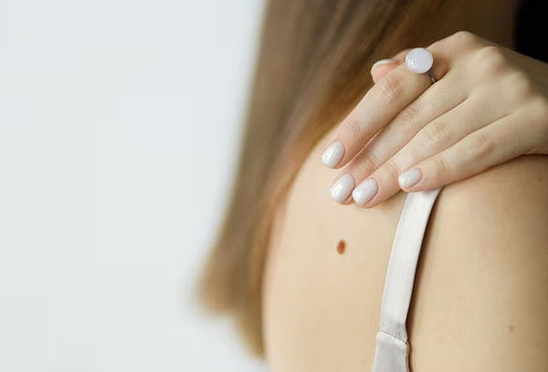 Eliminacion de Lunares o Puntos Rubí + Diagnostico