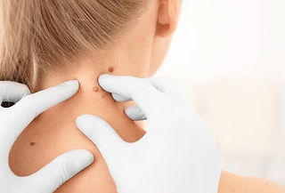 Eliminación de Acrocordones sin dolor