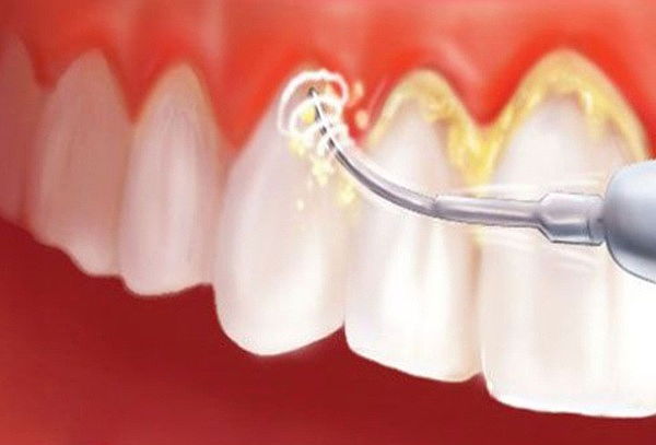 Limpieza Dental: Destartraje + Profilaxis + Flúor + Dx