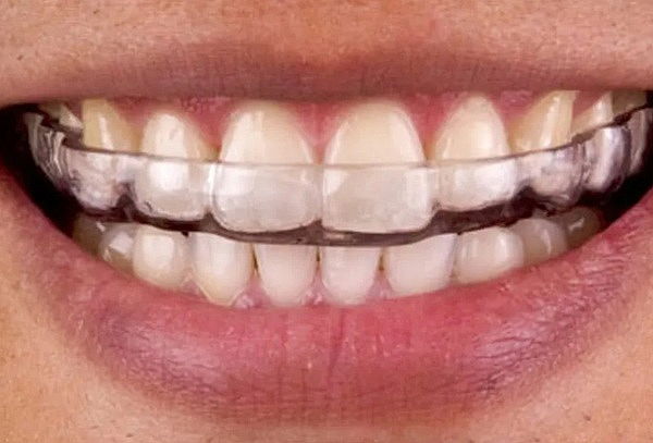 Ferula de Bruxismo + Consulta + Odontograma 