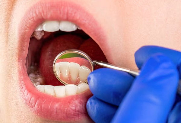 Destartaje con Ultrasonido + Profilaxis + Fluor