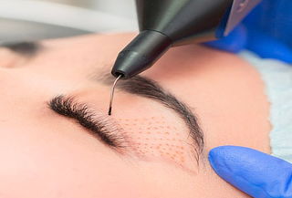 Rejuvenece Párpados sin Cirugía con Fibroblast Plasmapen 