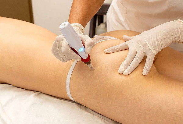 Tratamiento Avanzado para Estrías con Fibroblast Plasmapen
