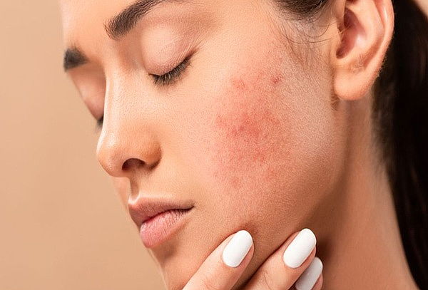 Facial Premium Especializado para Piel Grasa y Acneica