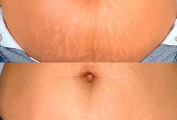 Elimina Estrías con Micropuntura Brasileña - Zona a Elegir