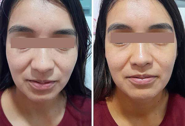 Hollywood Peel con Láser Pico-Segundo Portátil Neatcell