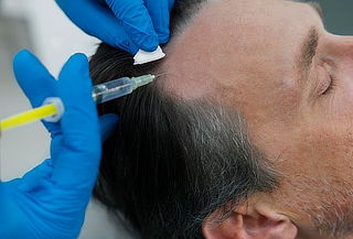 Tratamiento Anticaída: PRP Capilar + Cóctel de Minoxidil