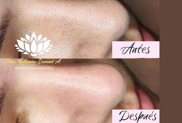 Limpieza HydraFacial 6 en 1 con Ácido Hialurónico + Kit 