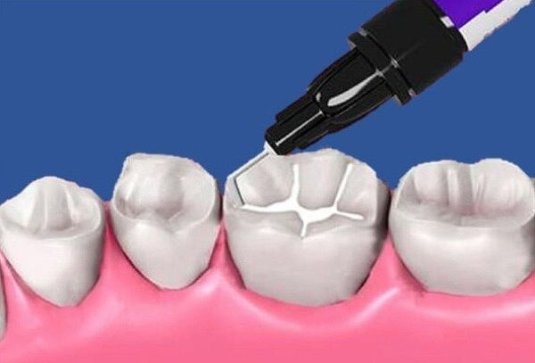 4  Curaciones Simples con Resina o Sellantes + Fluorización