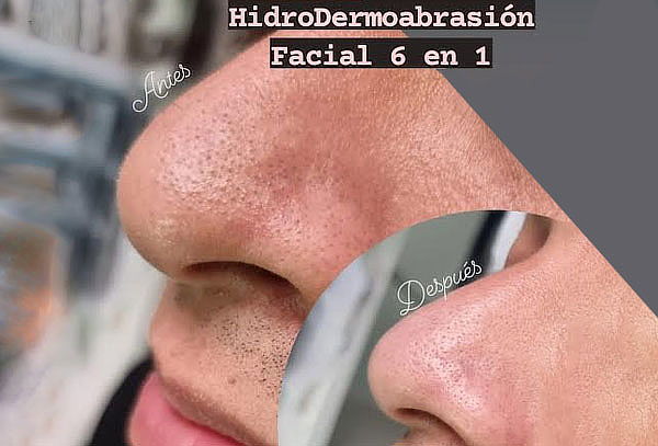 Limpieza HydraFacial 6 en 1 con Ácido Hialurónico + Kit 