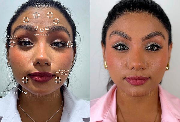 ¡Rejuvenece! Toxina Botulínica FULL FACE 