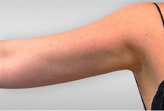 Lipo brazos en Medellin Plastic Surgery
