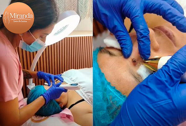 Eliminación de Acrocordones en 5 Sesiones