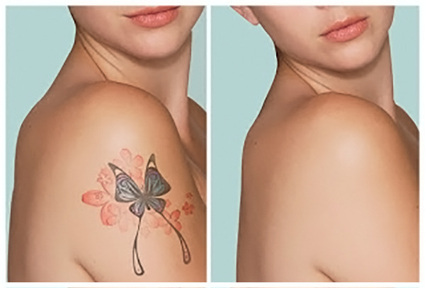 Eliminación de Tatuajes con Tratamiento Láser 90%  