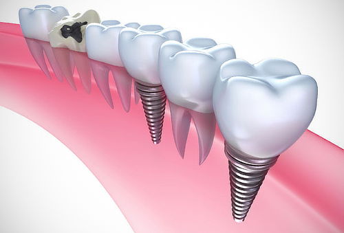 Resultado de imagen de implante dental