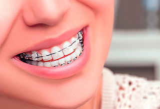 ¡Obten una linda Sonrisa! Brackets + Limpieza y Más