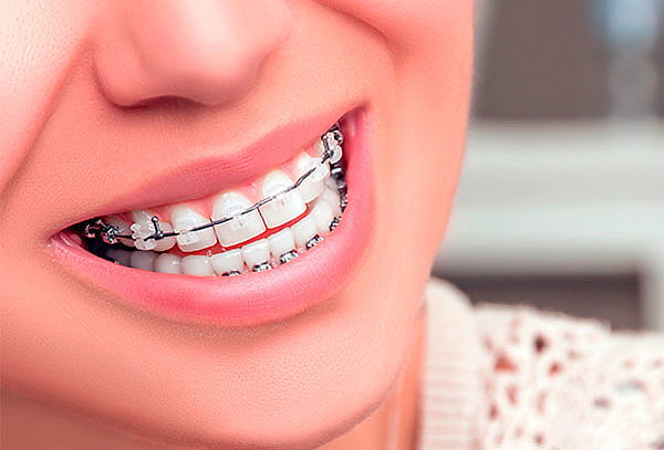 ¡Obten una linda Sonrisa! Brackets + Limpieza y Más