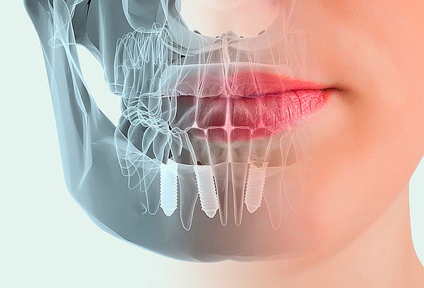 Precio de implantes dentales en peru Precio de implantes dentales en peru