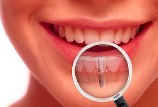 Implante Dental de Titanio en Virtual Dent